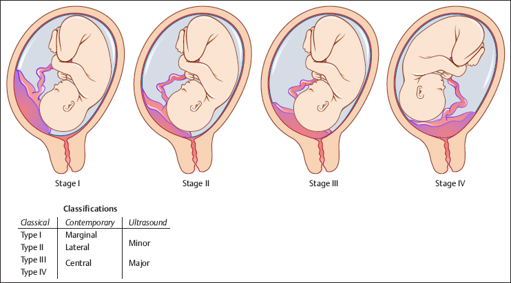 placenta previa 4 type
